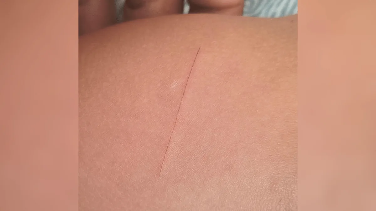 Criança inicia tratamento contra HIV após corte em escola
